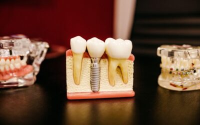 Explore The Magic World of Dental Implants With a Dentist in Fairfield