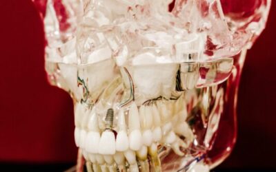 The Four Main Benefits of Dental Implants