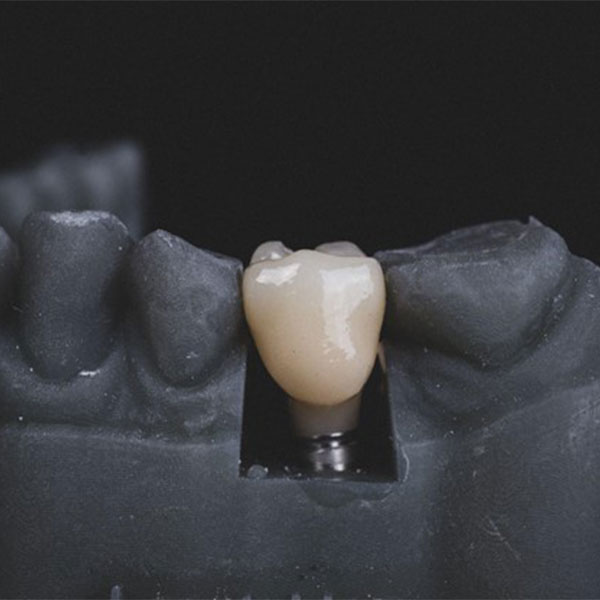 A tooth crown rests on a dental implant