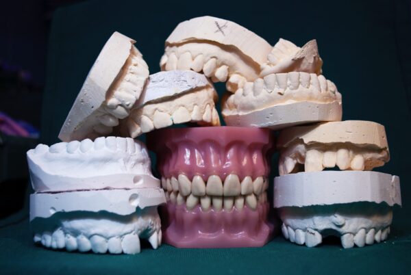 Dental casts in a pile, indicating a prosthodontist in Fairfield, CT