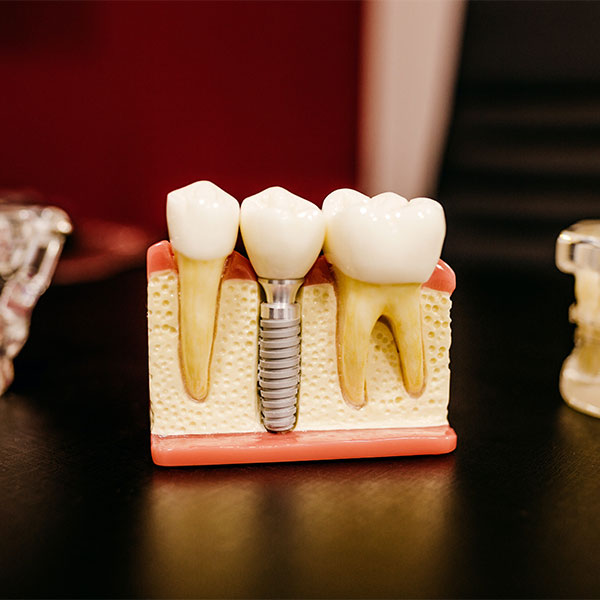 A plastic model displaying what a tooth implant looks like in the jawbone