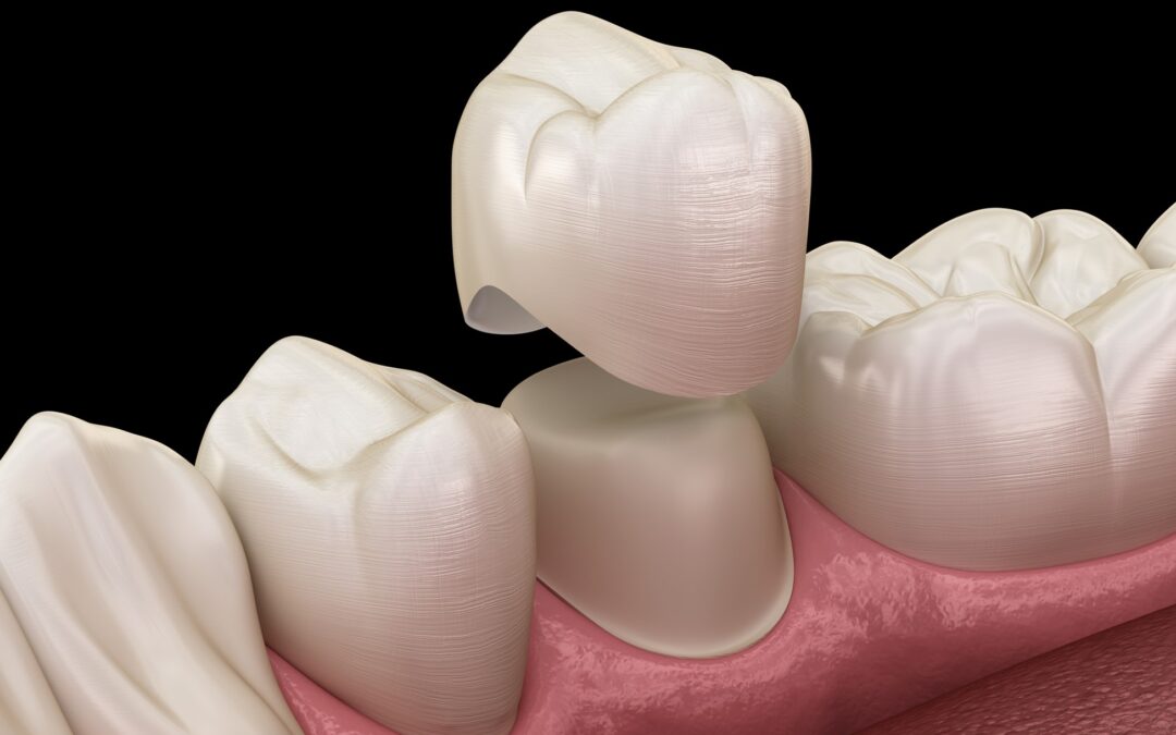 Six Ways to Repair Your Smile With a Tooth Cap