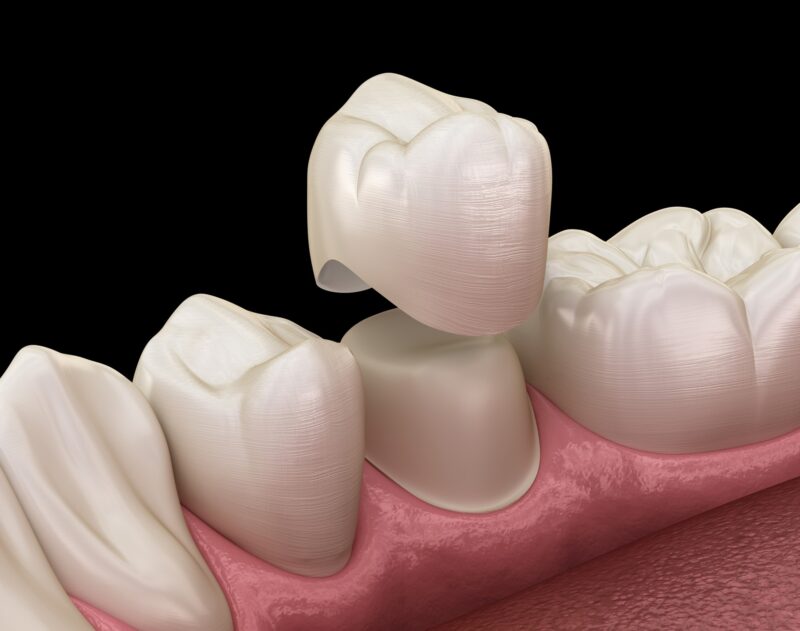 A 3D depiction of a tooth cap fitted over a natural tooth
