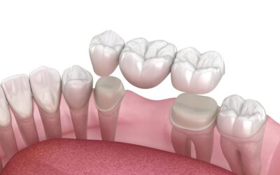 How to Properly Clean a Dental Bridge