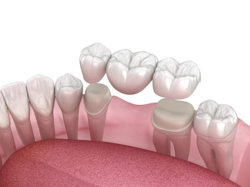 A digital rendering of a dental bridge positioned over natural teeth