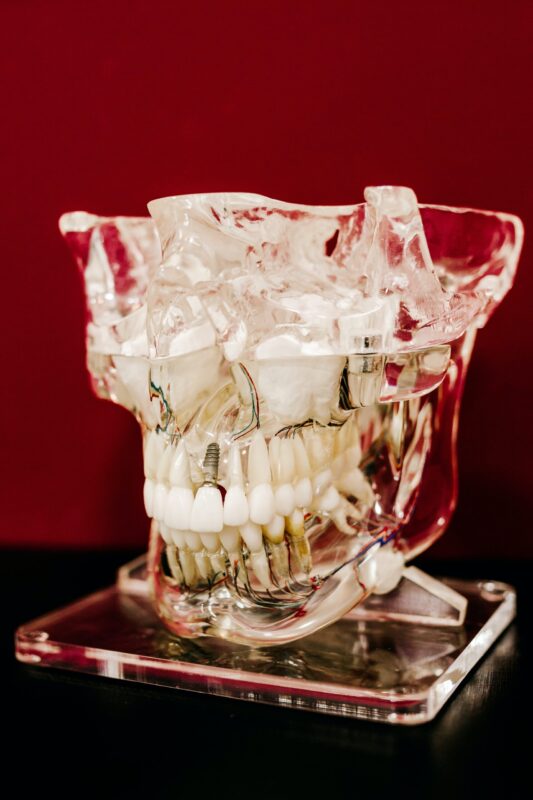 A clear, plastic skull displays the way dental implants fit in the jaw