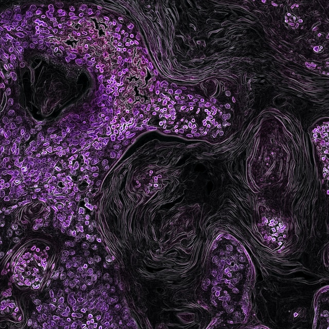 Colorized image of cells affected by oral cancer under a microscope
