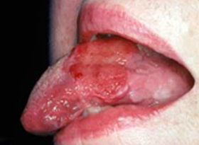 Oral Cancer on Tongue