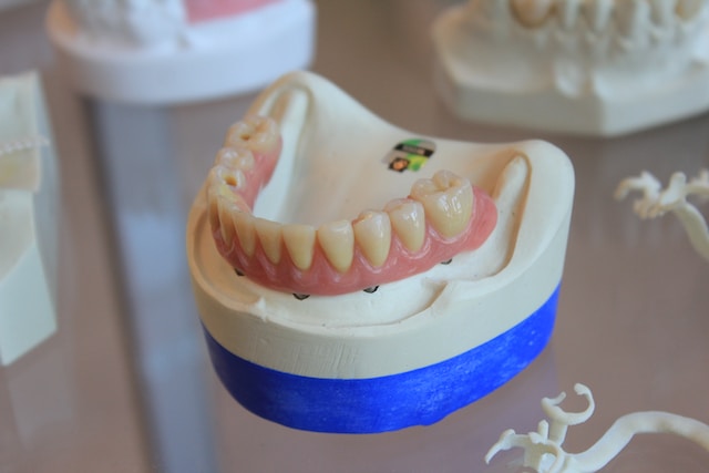 Implant-supported dentures displayed on a dental cast