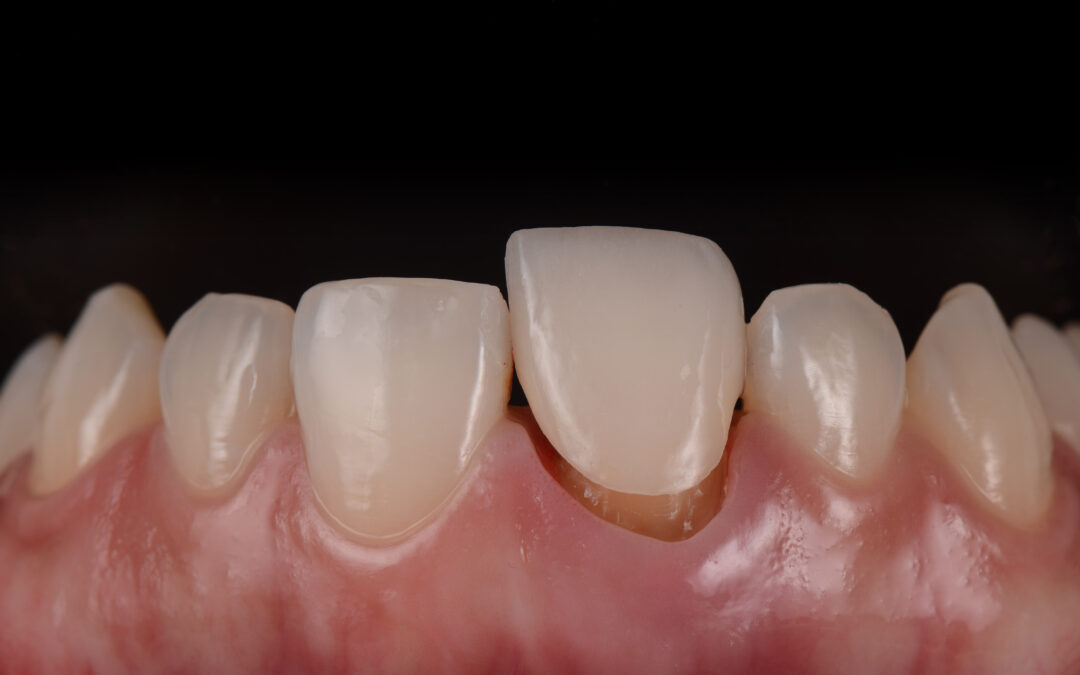 How do I know if I need a tooth crown?