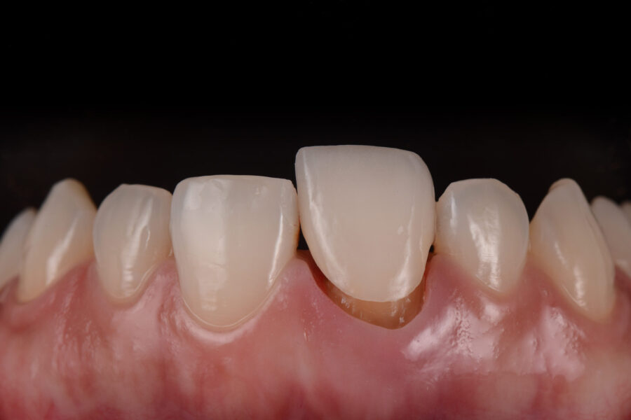 A 3D rendering of how a tooth crown sits atop a natural tooth.
