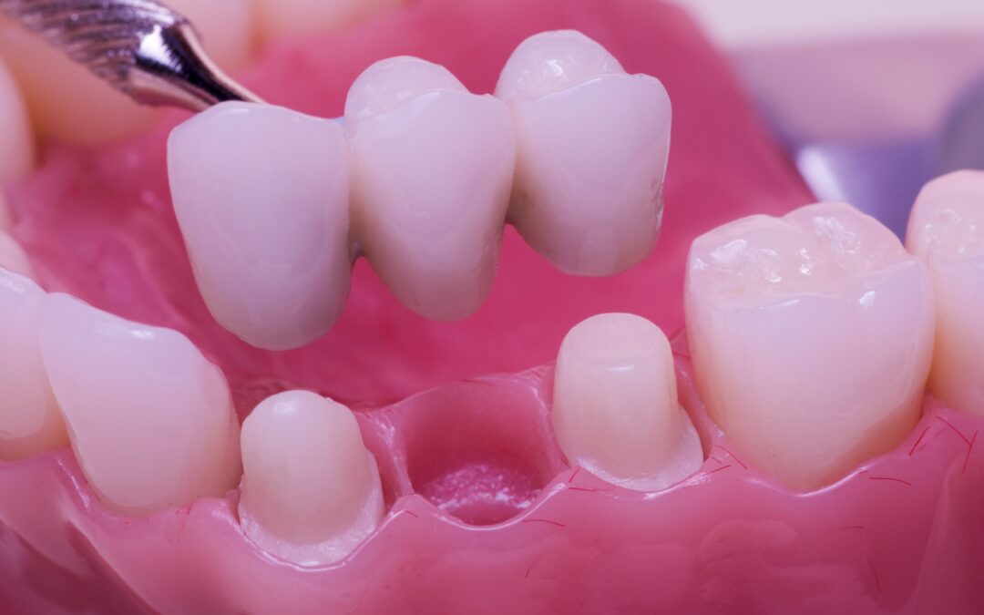 Is a dental bridge right for you? Find out now!