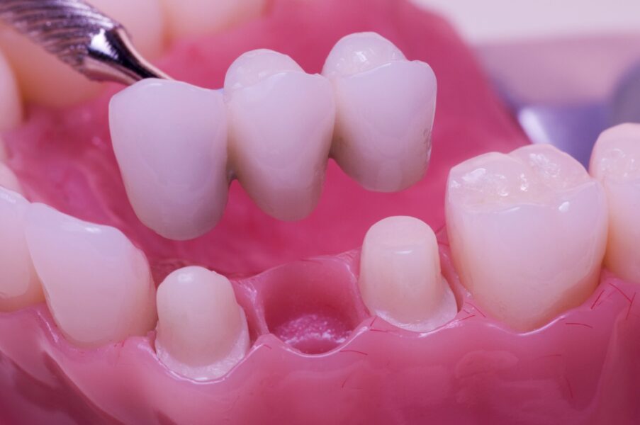 3D rendering of how a dental bridge sits atop adjacent teeth