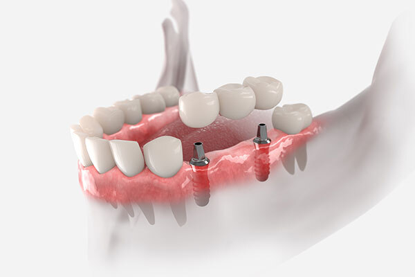 What to Expect During the Dental Implant Procedure