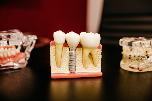 Explore The Magic World of Dental Implants With a Dentist in Fairfield
