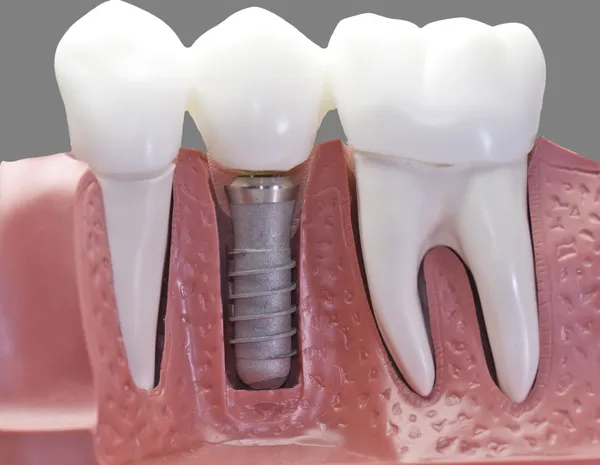 Taking Care of Your New Dental Implants