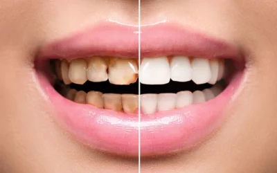 8 Cosmetic Uses for Dental Crowns