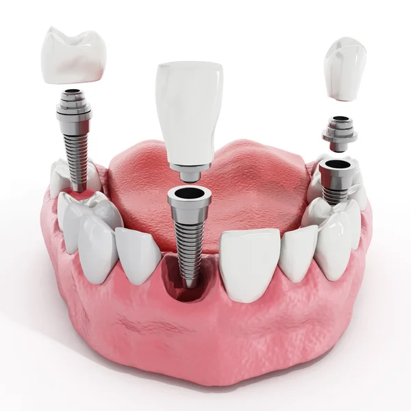 5 Reasons You May Need Dental Bone Grafting