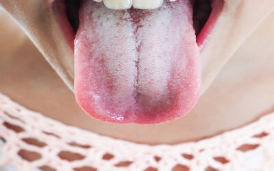 Ask a Dentist in Fairfield, Connecticut: Why is my tongue white?