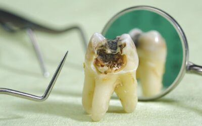 Can tooth decay cause other health problems?