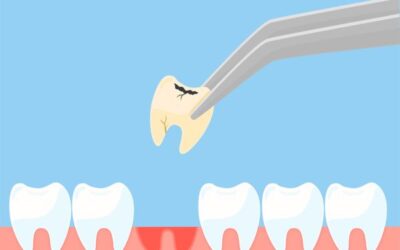 Dentist in Fairfield, Connecticut, Explains Simple and Surgical Tooth Extractions