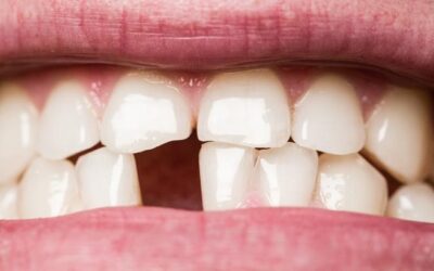 Embracing the Unexpected: Overcoming Embarrassment About Losing Teeth