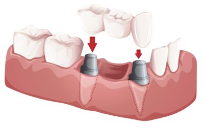 Common Questions About Partial Dental Implants Answered by Your Dentist in Fairfield, Connecticut