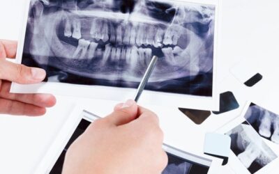 Holiday Extractions: What to Know Before Scheduling a Tooth Removal During the Holidays