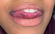 Oral piercings in Relation to Dental Problems