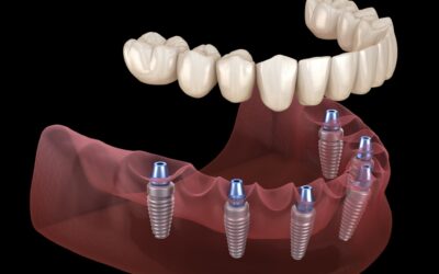 Tired of Traditional Dentures? Try Dental Implants Instead!