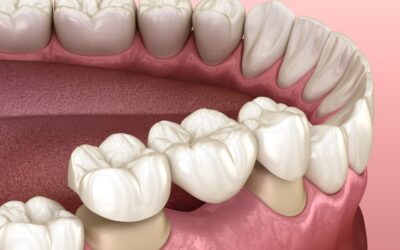 Signs Your Dental Bridge Needs Repair or Replacement