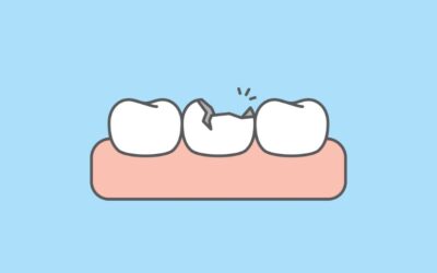 What Should I Do If I Have a Cracked or Broken Tooth?