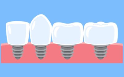 Top 3 Dental Implant Questions Answered