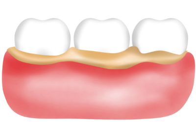 How Does Plaque Form, and How Do I Get Rid of It?