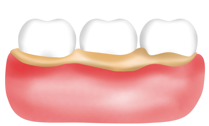april26d Gum recession with yellow tartar buildup along the gum line beside three molars in the lower jaw relief.