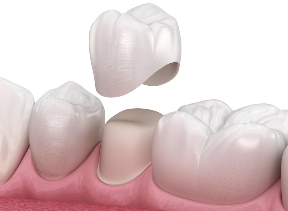 feb26-b Dental implant crown being placed onto a prepared tooth in the gum line (close-up rendering).