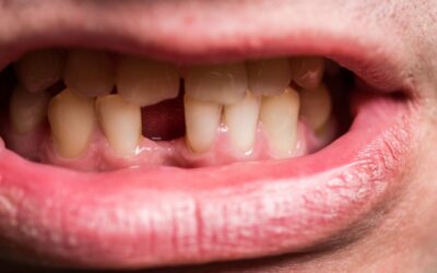 Replacing a Missing Tooth Is About More Than Appearance | Dentist in Fairfield, CT