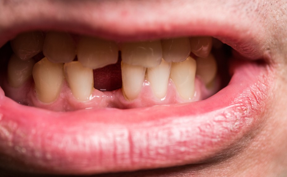 feb26a Close-up of a mouth with a missing upper front tooth, showing surrounding teeth and gums in a smile.