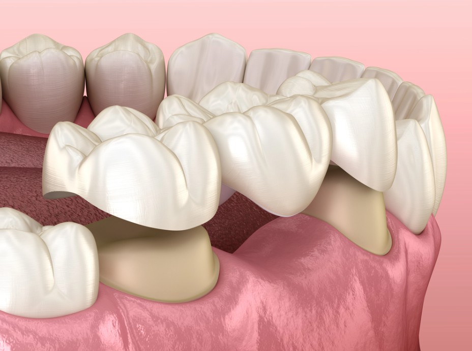 3D dental illustration of an upper jaw showing prepared tooth stubs for a dental bridge over pink gum tissue with adjacent natural teeth and a missing tooth space