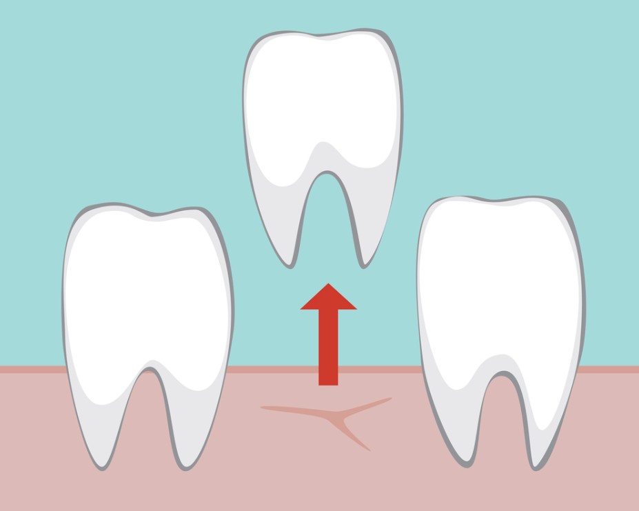 feb26d Tooth eruption diagram showing a tooth moving upward through the gum between two neighboring teeth.
