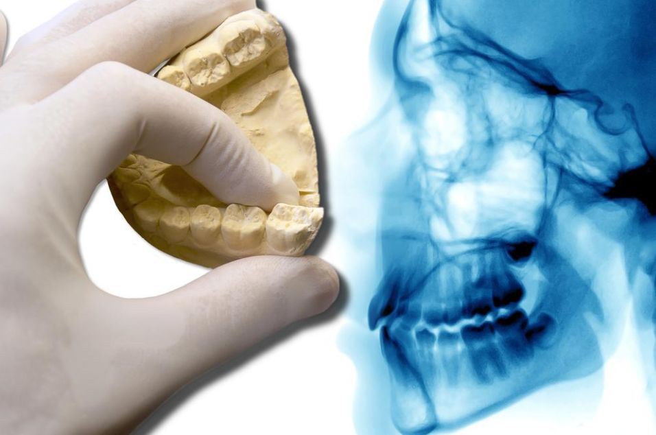 Gloved hand holds a dental mold beside a side X-ray image of a skull to compare bite and teeth structure.