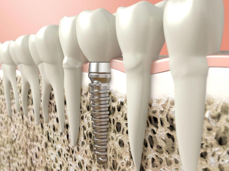 june-d 3D illustration of a dental implant anchored in the jawbone beside natural teeth