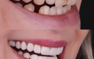 What Is Full Mouth Reconstruction? Here’s Why It’s Different From a Smile Makeover