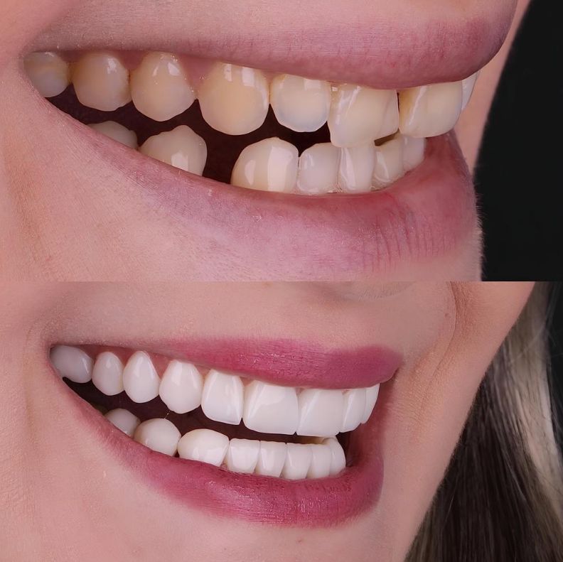 may-b Before-and-after comparison of a smile: top image shows yellow, crowded teeth; bottom image shows whiter, straighter teeth with fuller smile.