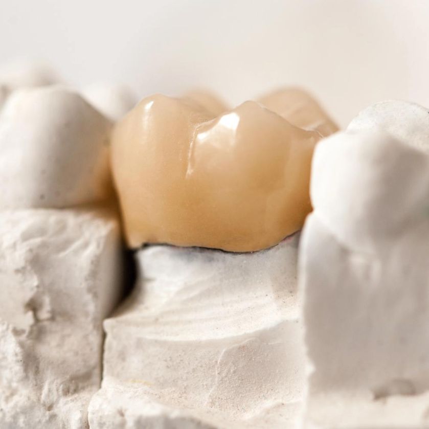 Dental model showing a beige crown on a prepared tooth set in a plaster cast (dental model).
