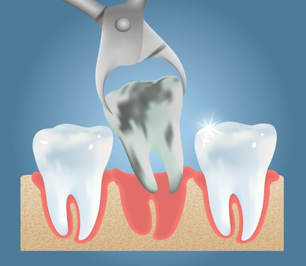 may26d Illustration of a dental extraction: forceps pulling a damaged tooth between two healthy teeth in the gums